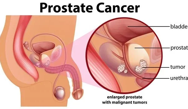 Kanker Prostat: Tes PSA untuk Pria Usia Menengah ke Atas
